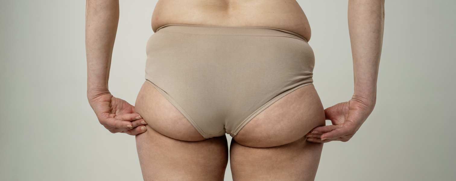 Brazilian Butt Lift (BBL)