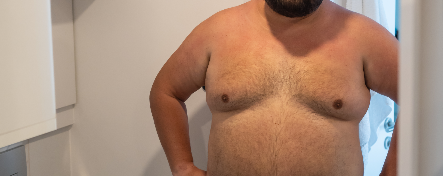 Gynecomastia Surgery