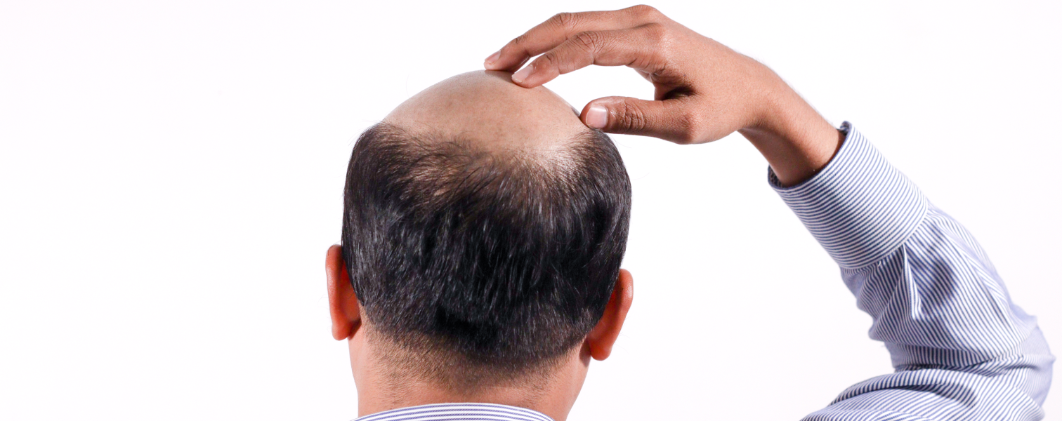 Shaven Hair Transplantation