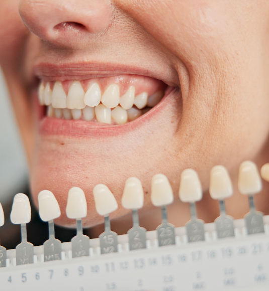 Understanding Composite Bonding: Benefits and Suitability