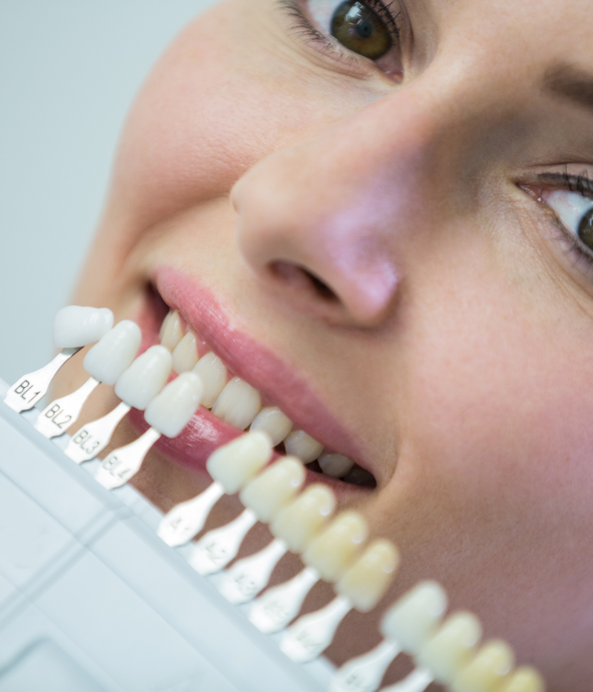 Veneers, Crowns, Implants: What Each One Is Actually For