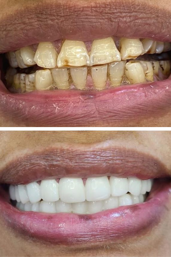 All Dental Alanya case 3