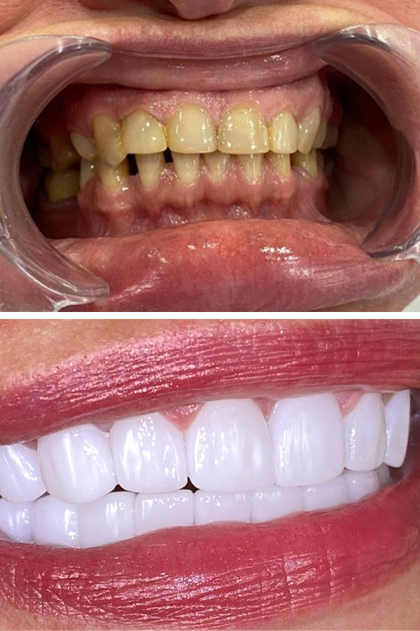 All Dental Alanya case 2