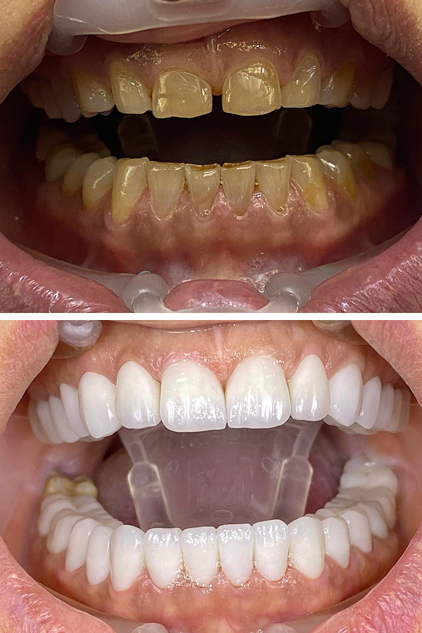 All Dental Alanya case 4