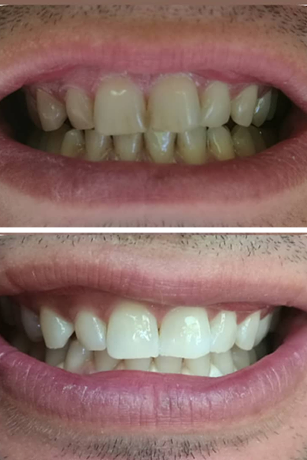 All Dental Alanya case 6