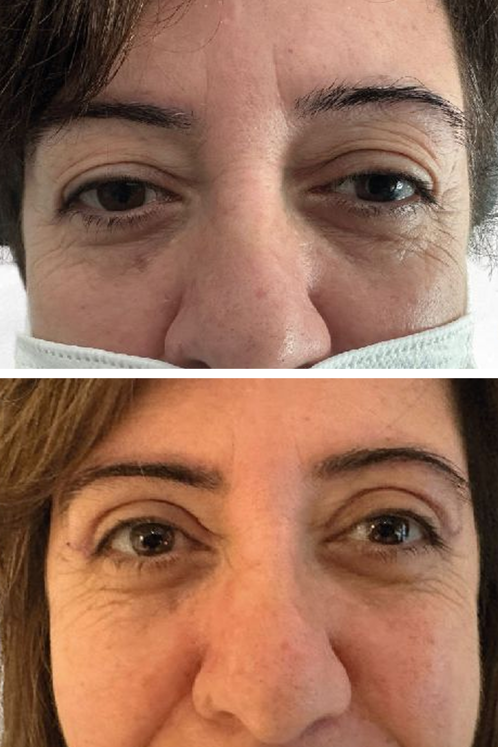 BHT Clinic's Blepharoplasty