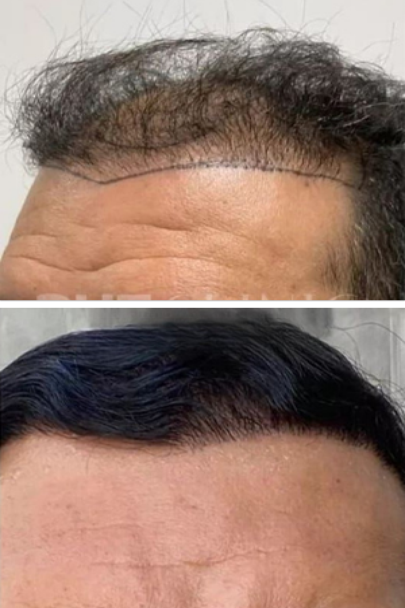 BHT Clinic's hair transplantation