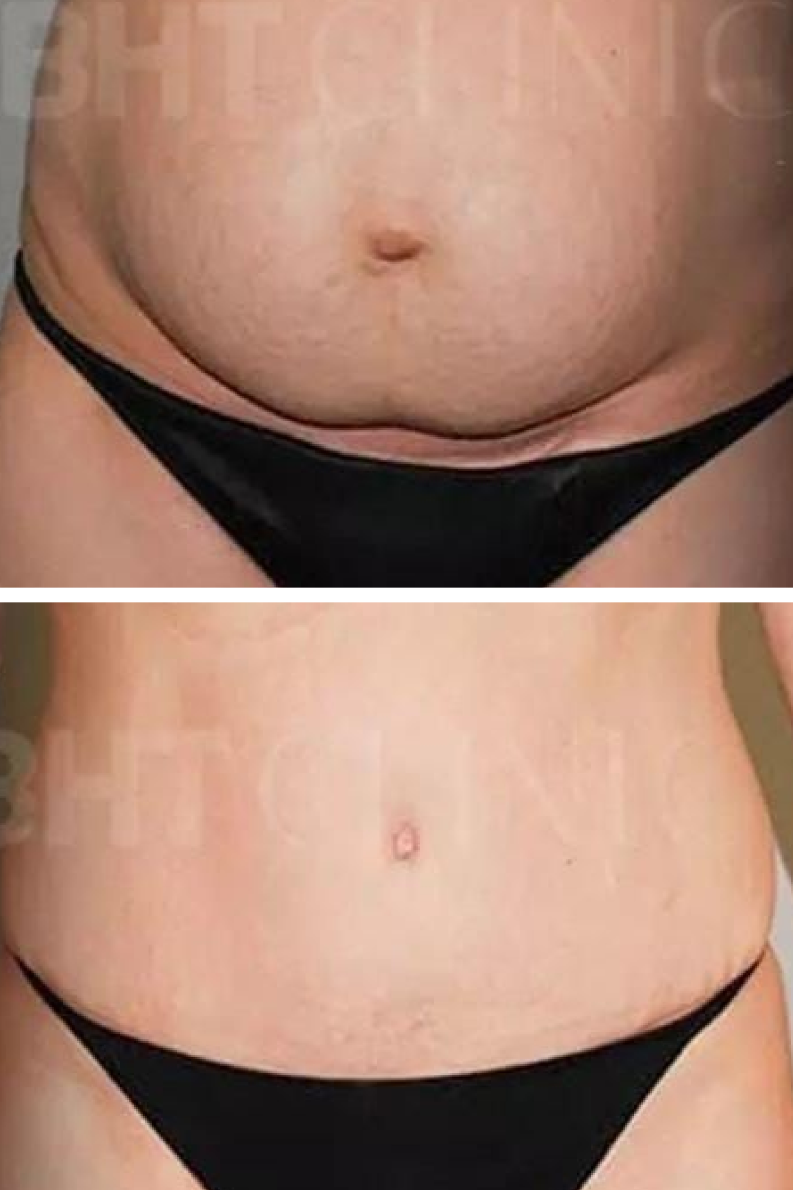 BHT Clinic's Tummy Tuck
