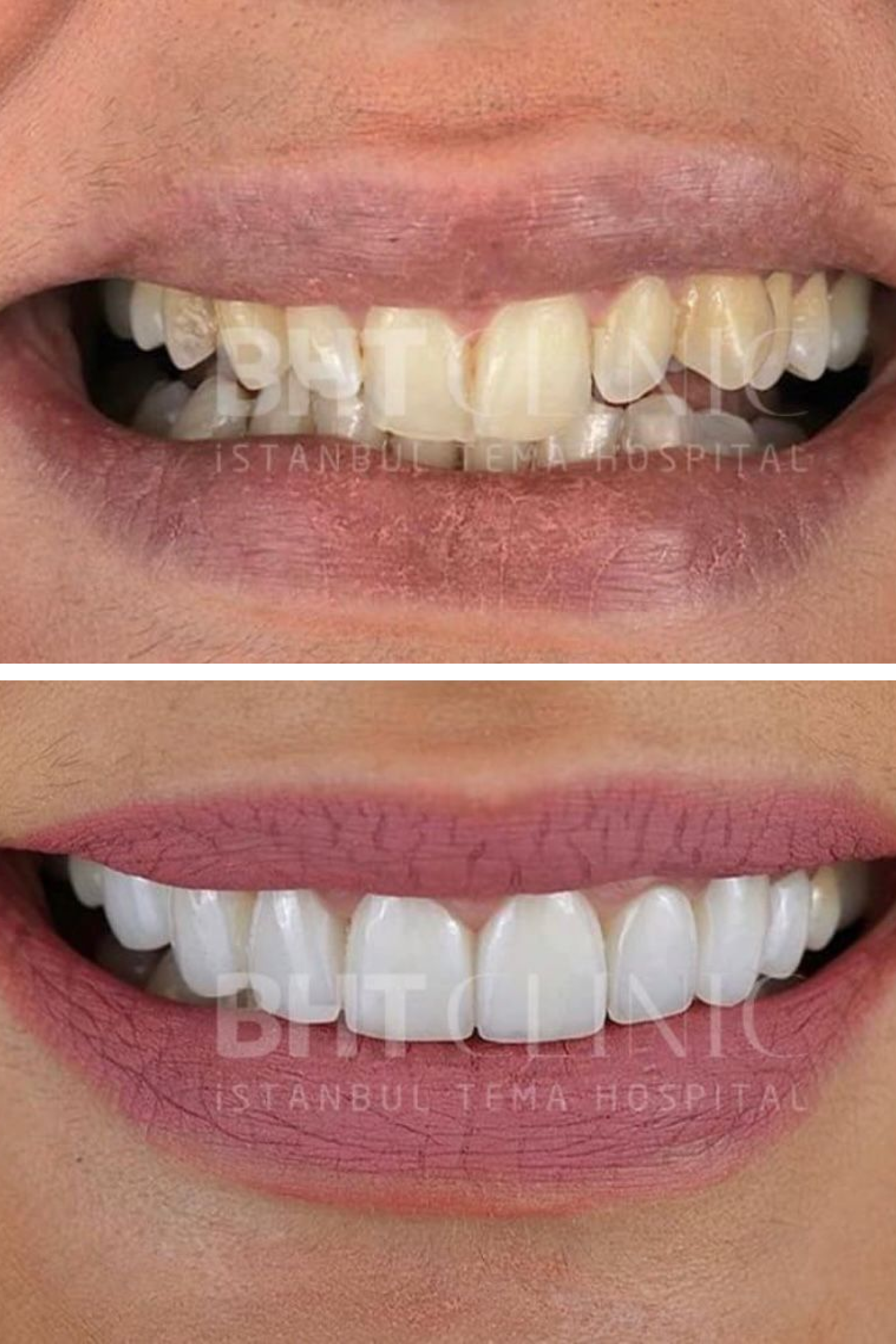 BHT Clinic's Composite Veneer