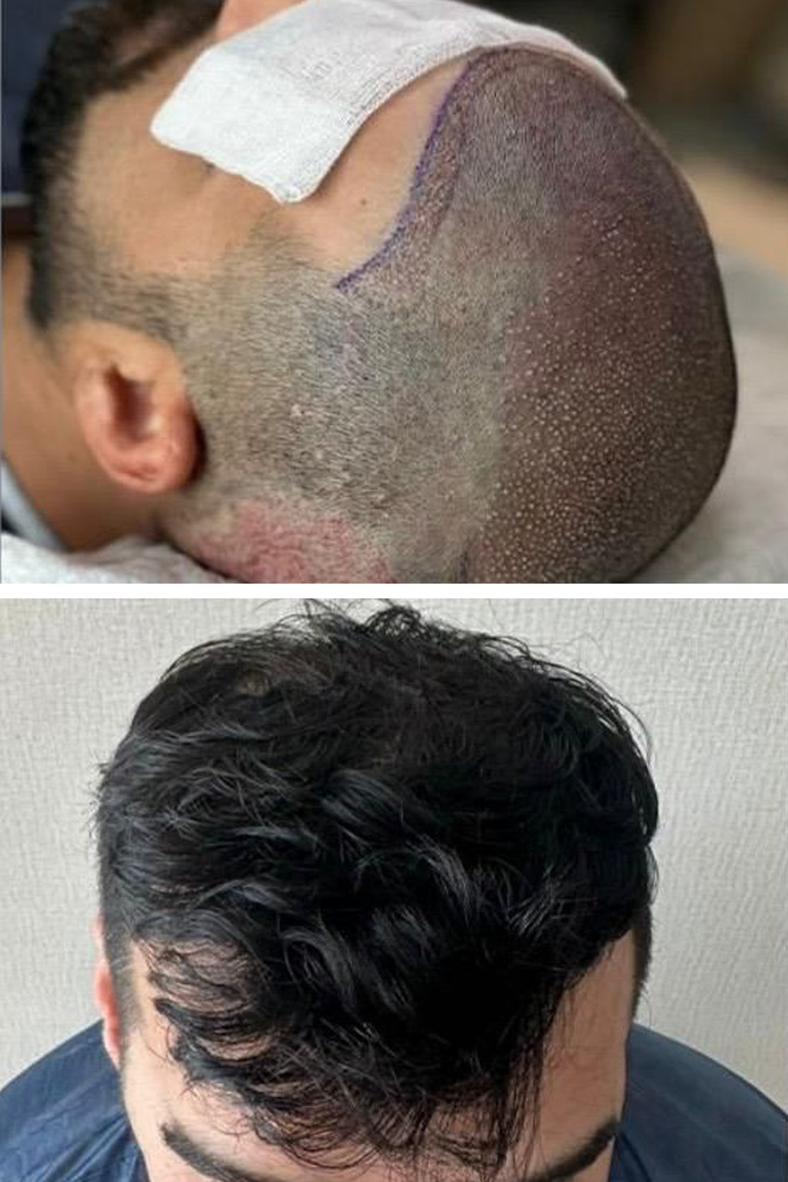 BHT Clinic's hair transplantation