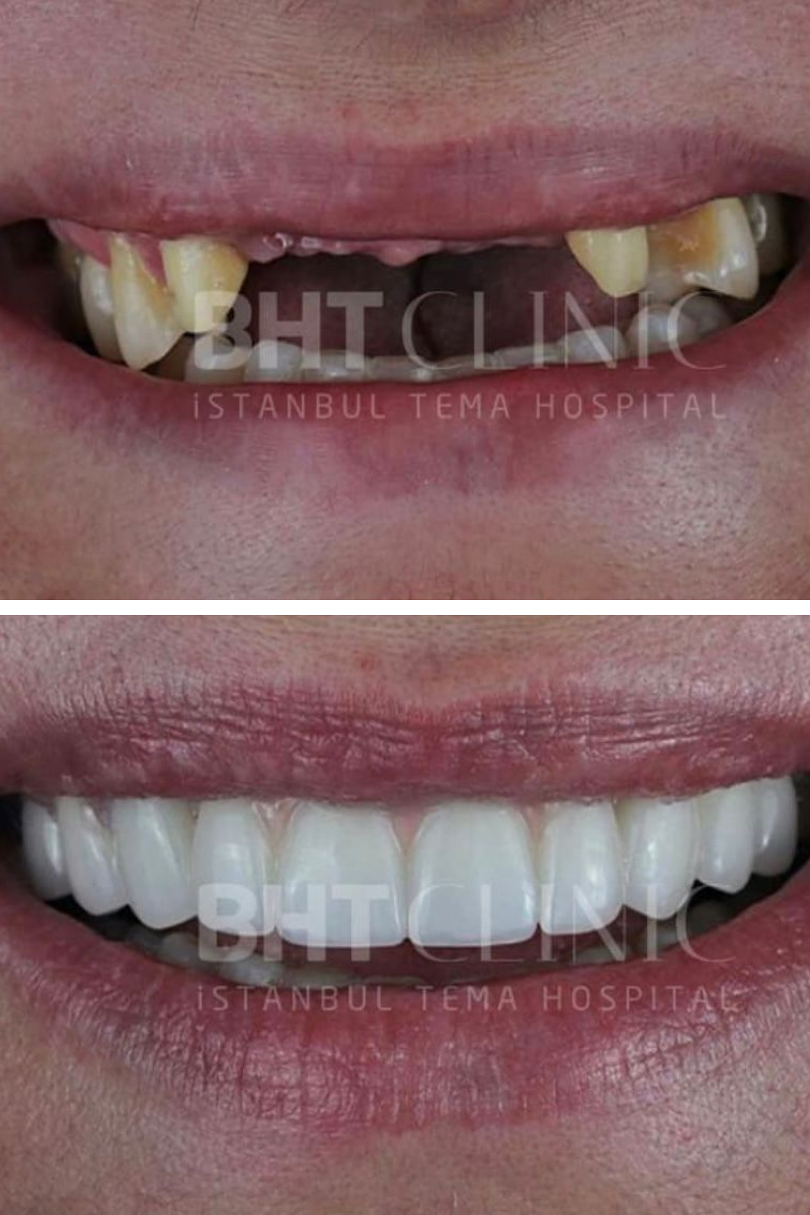 BHT Clinic's Composite Veneer