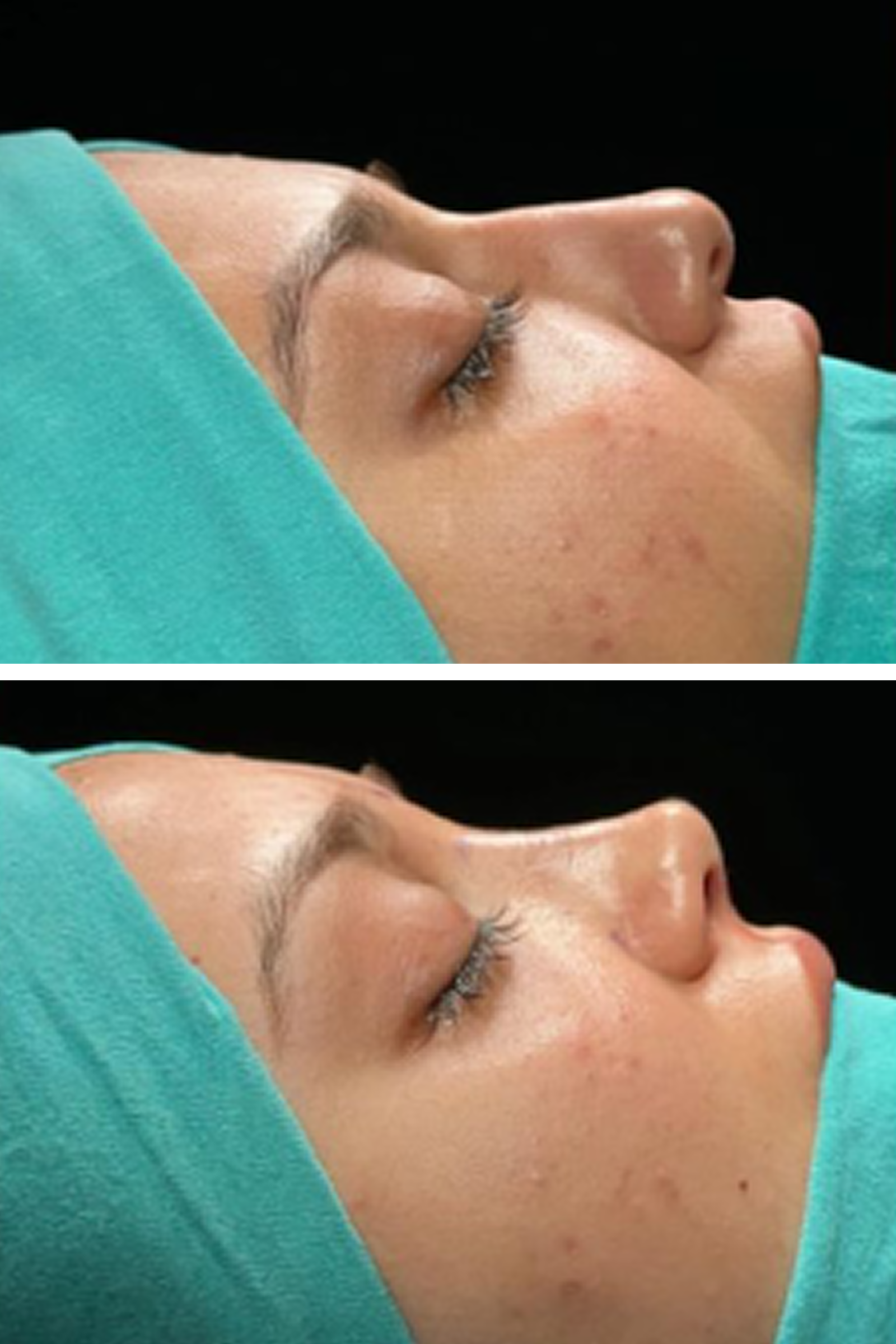 BHT Clinic's rhinoplasty