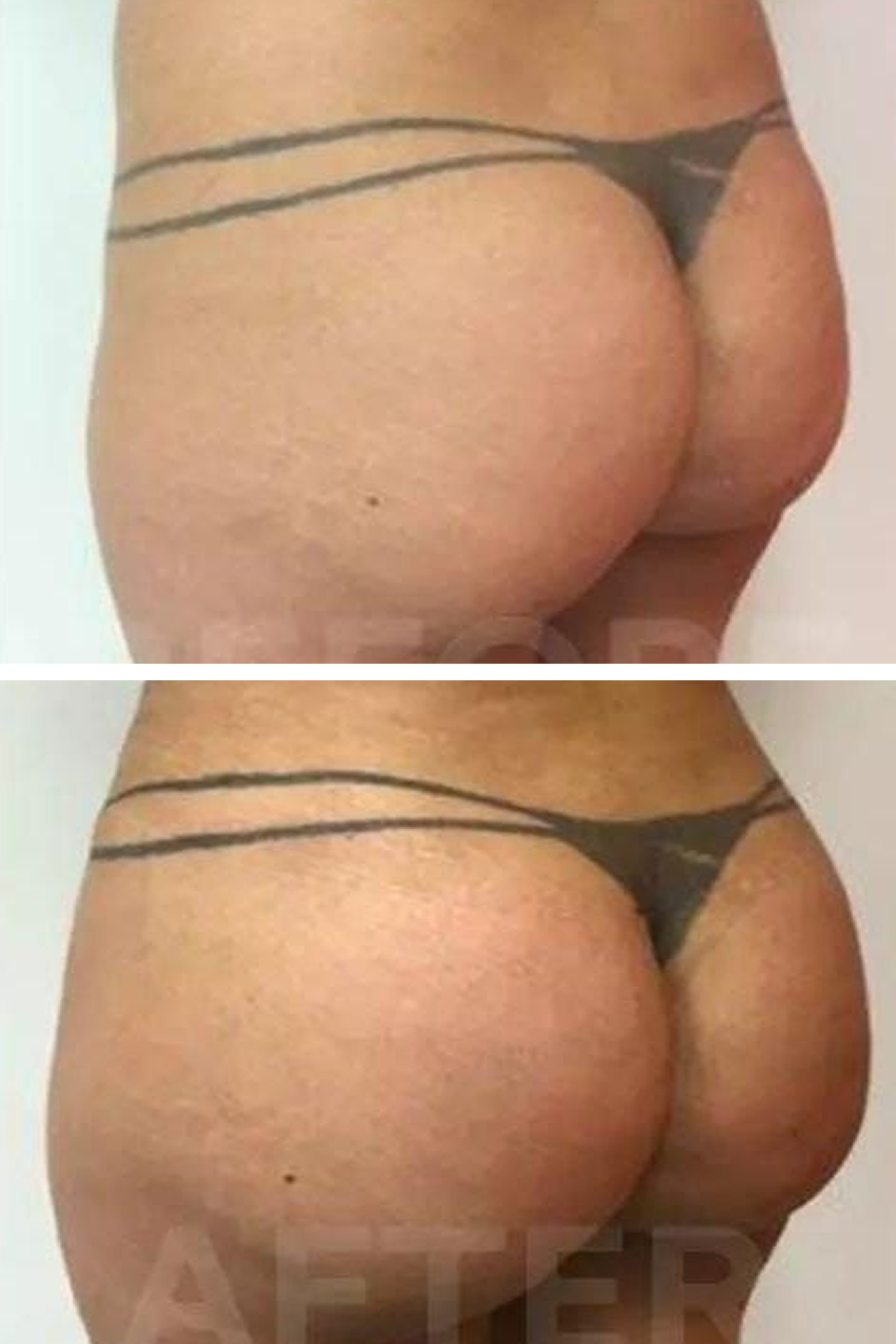 BHT Clinic's Thigh Lift