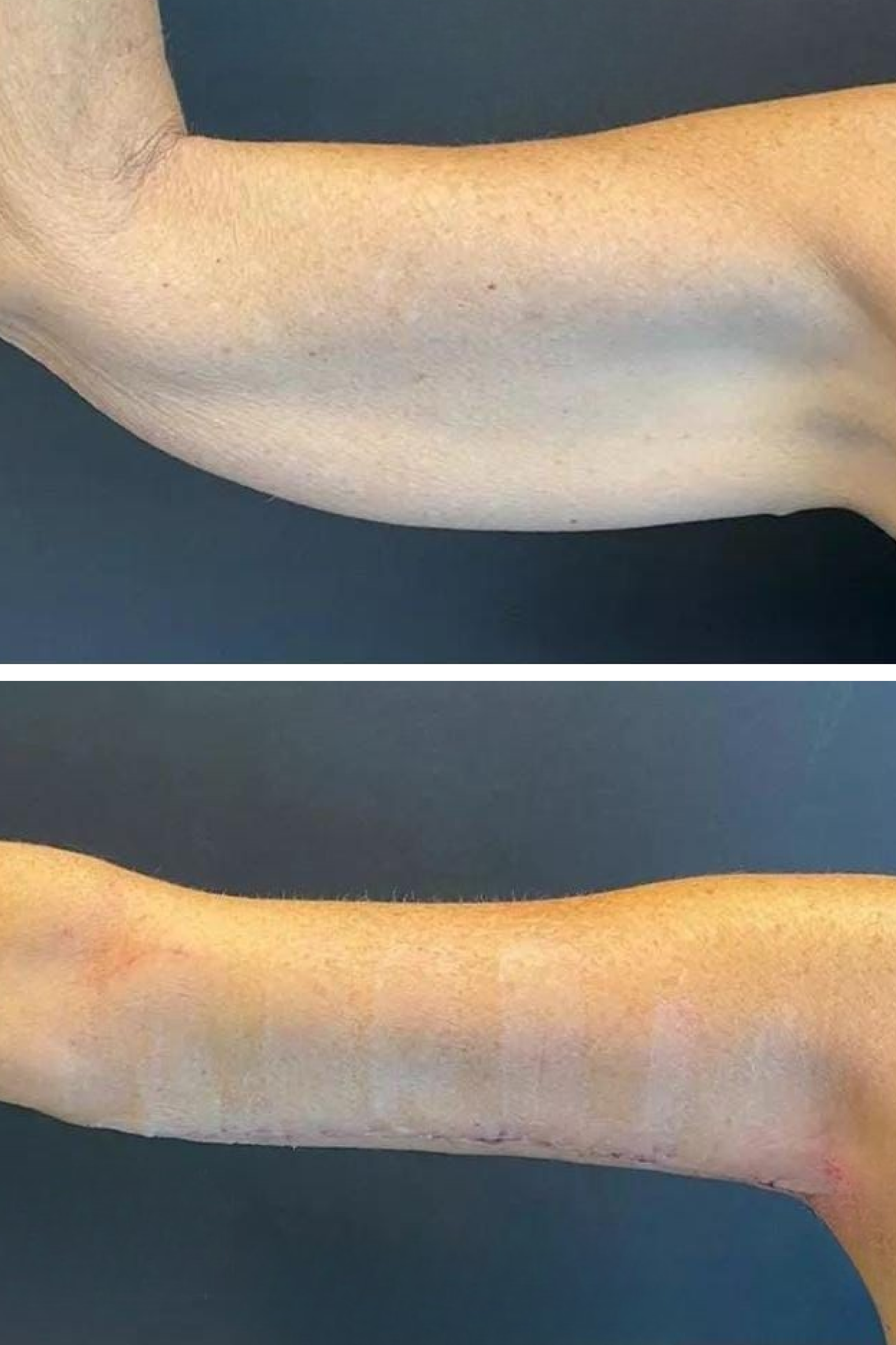 BHT Clinic's arm lift