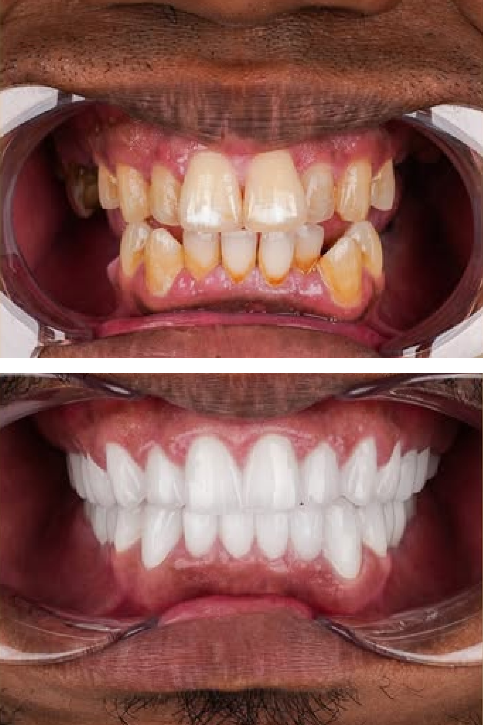 Dental Scaling