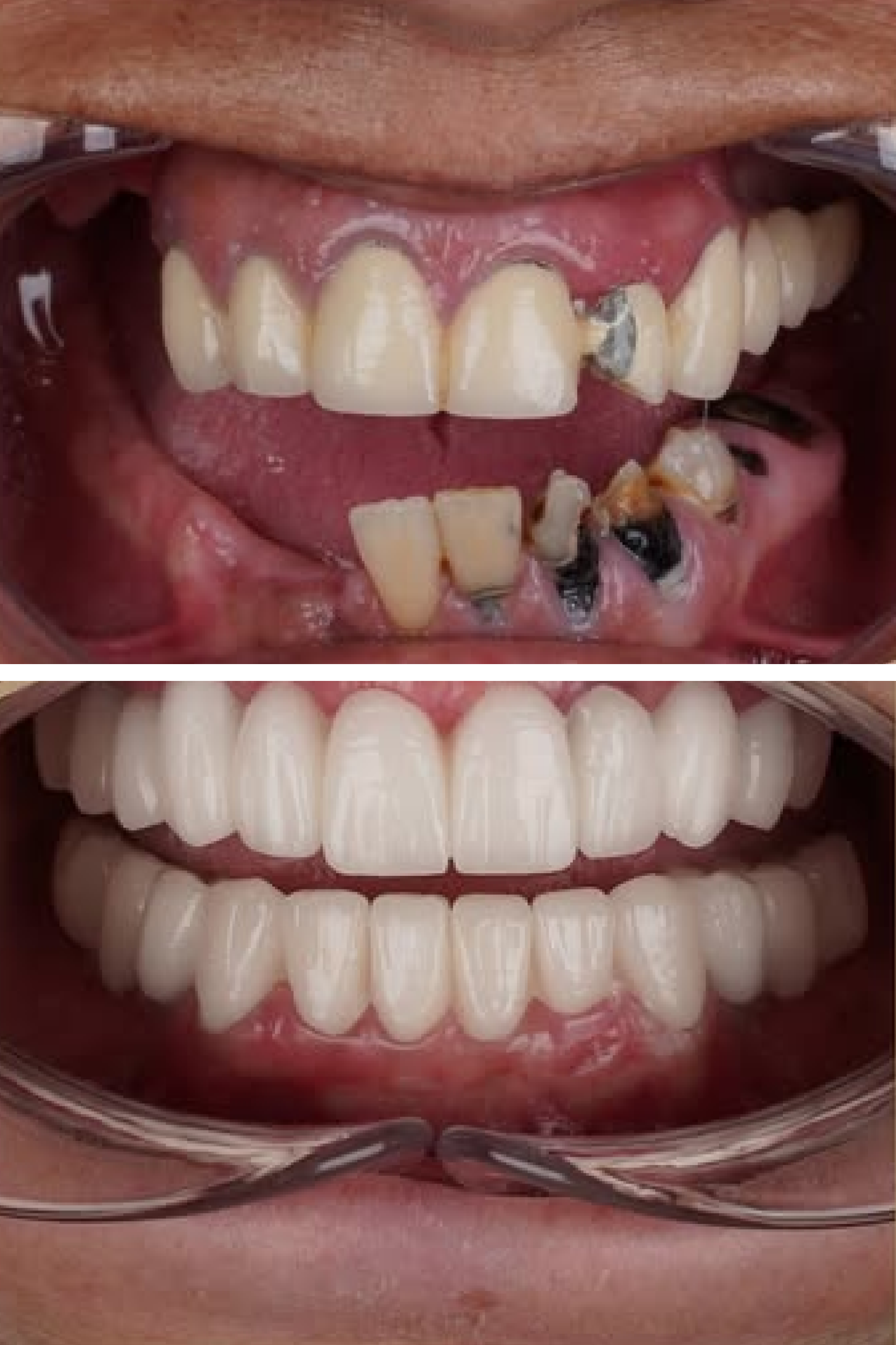 Porcelain Laminate Veneer