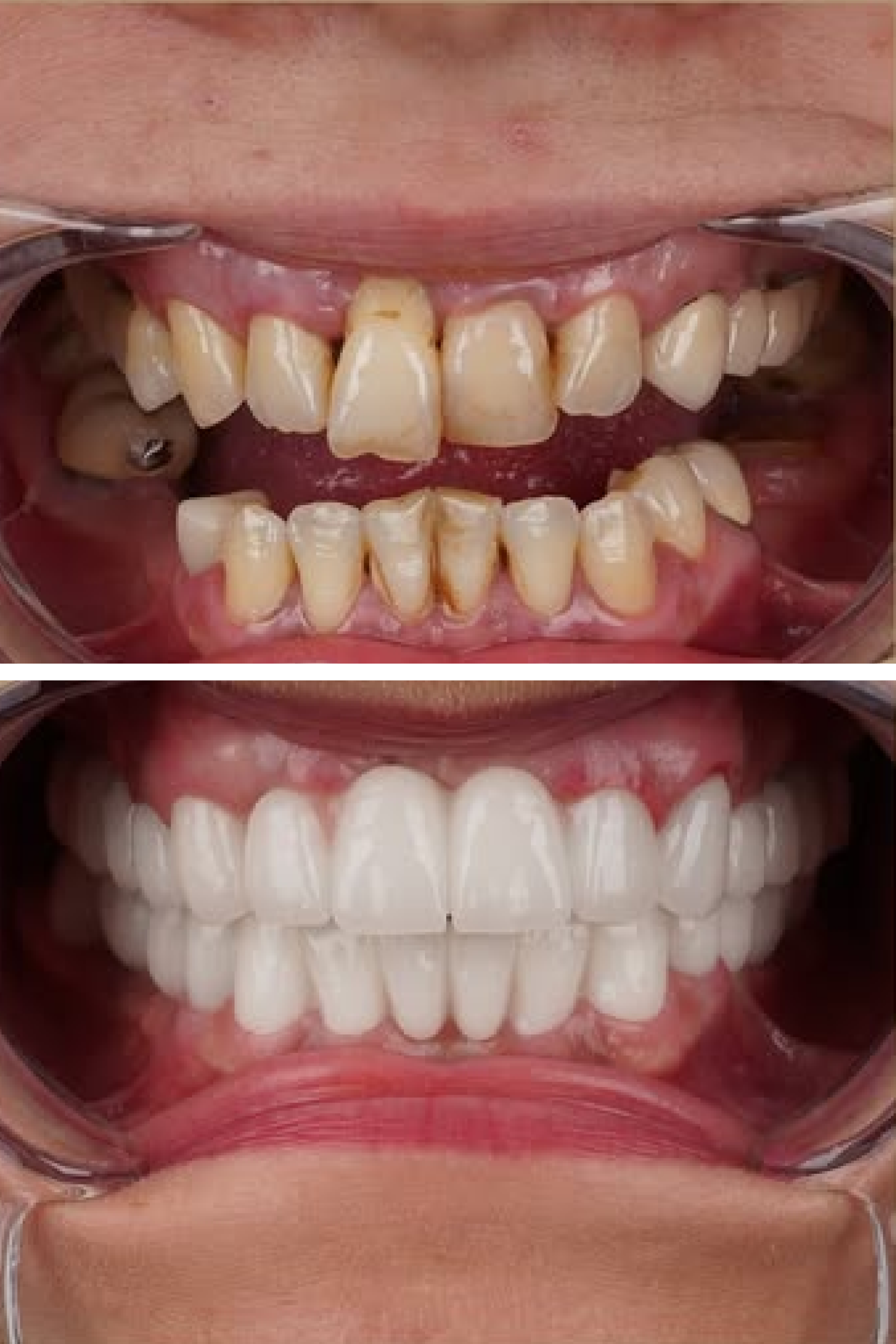 Invisalign Clear Aligners