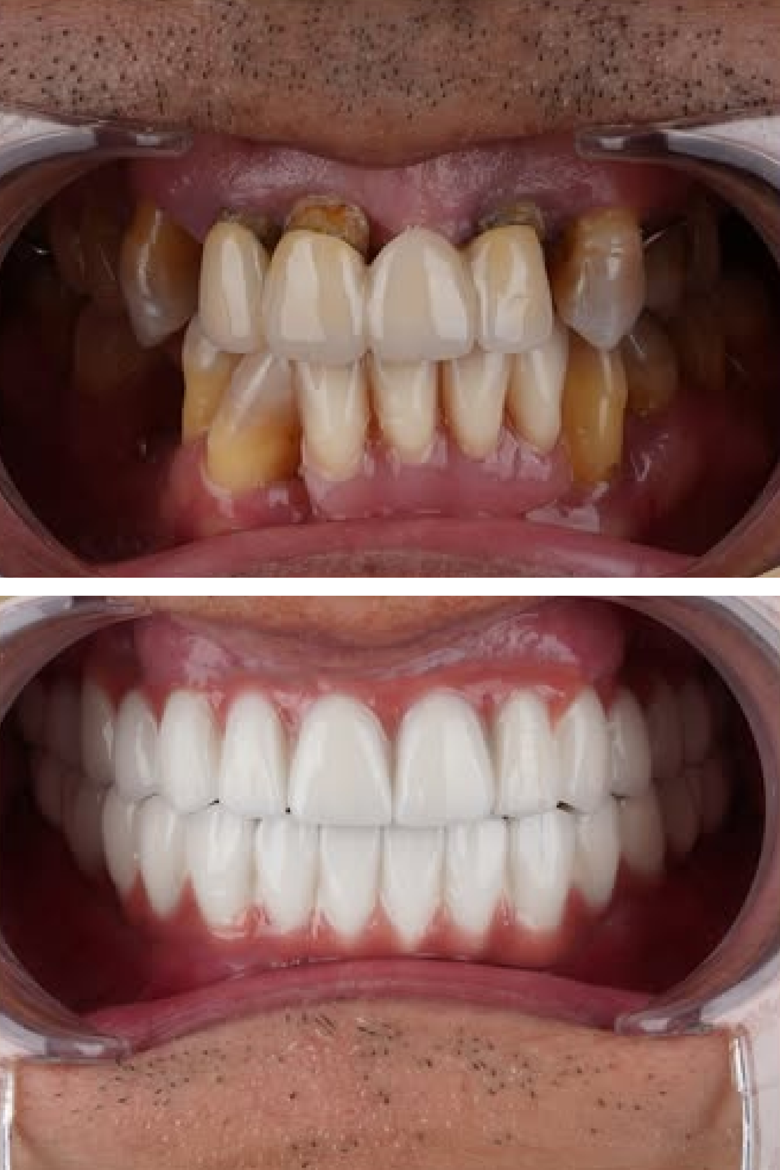 E-max Veneer