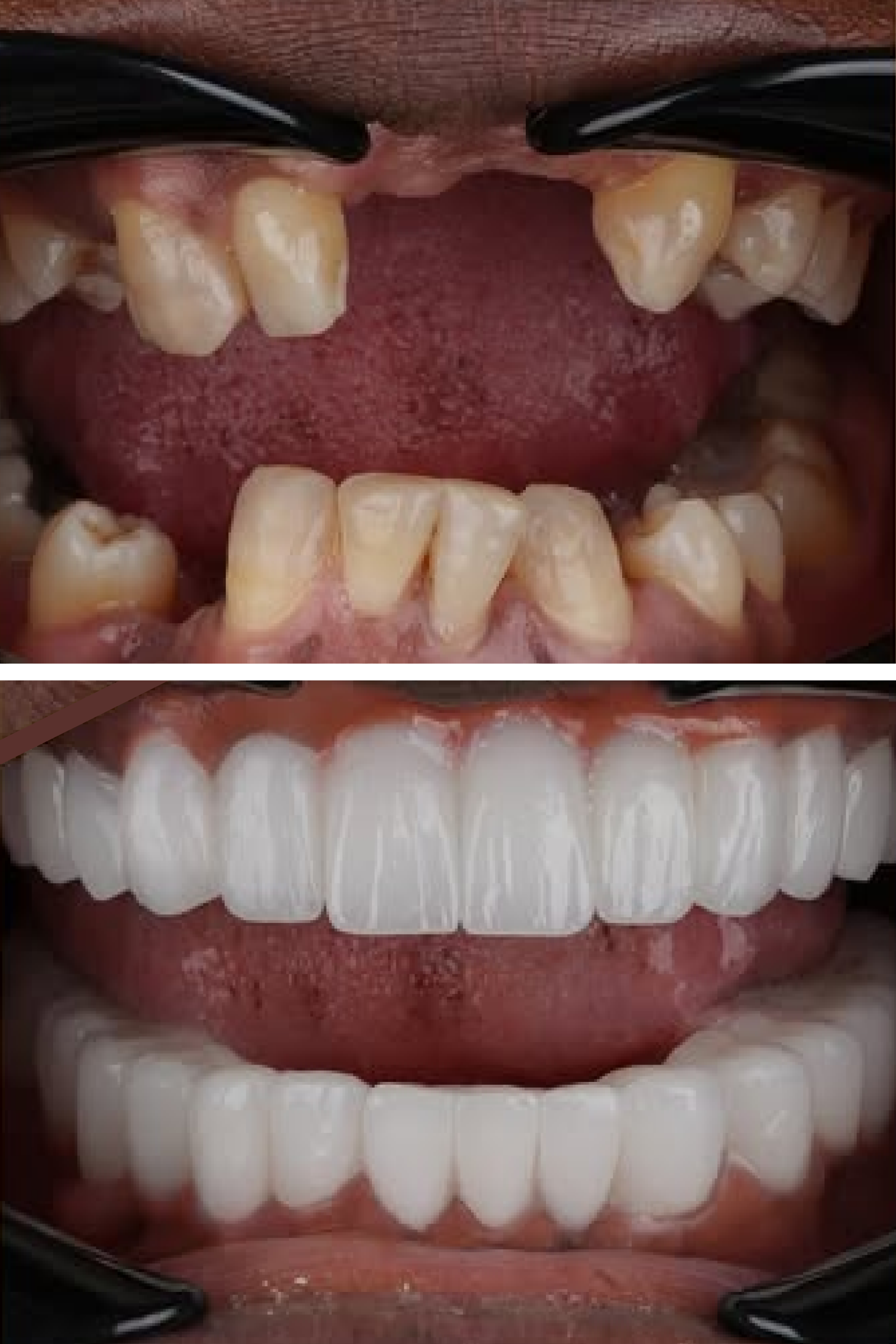 Single Dental Implant