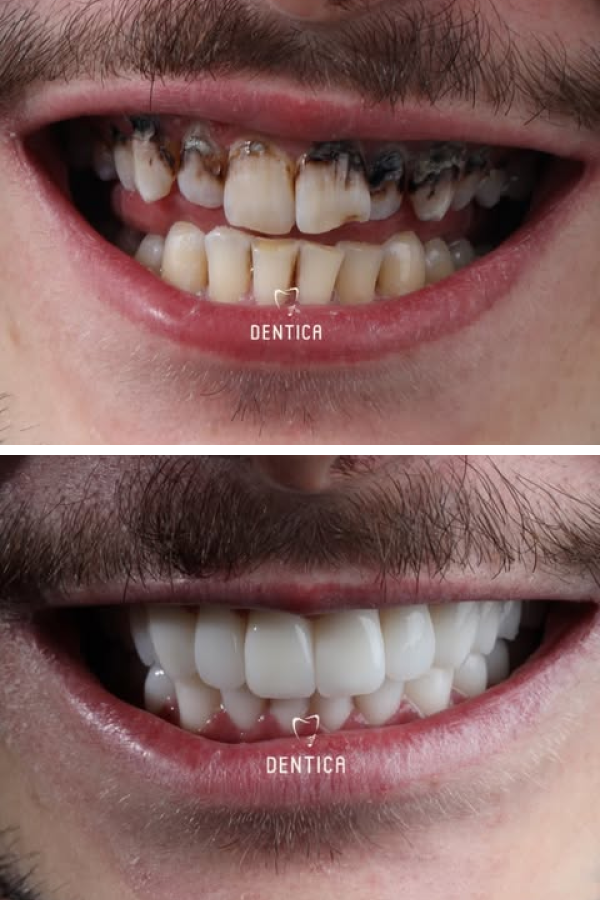 Dentica International — case