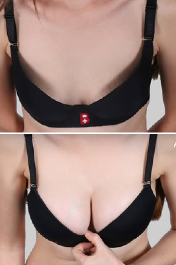 Estetik International's Breast Augmentation
