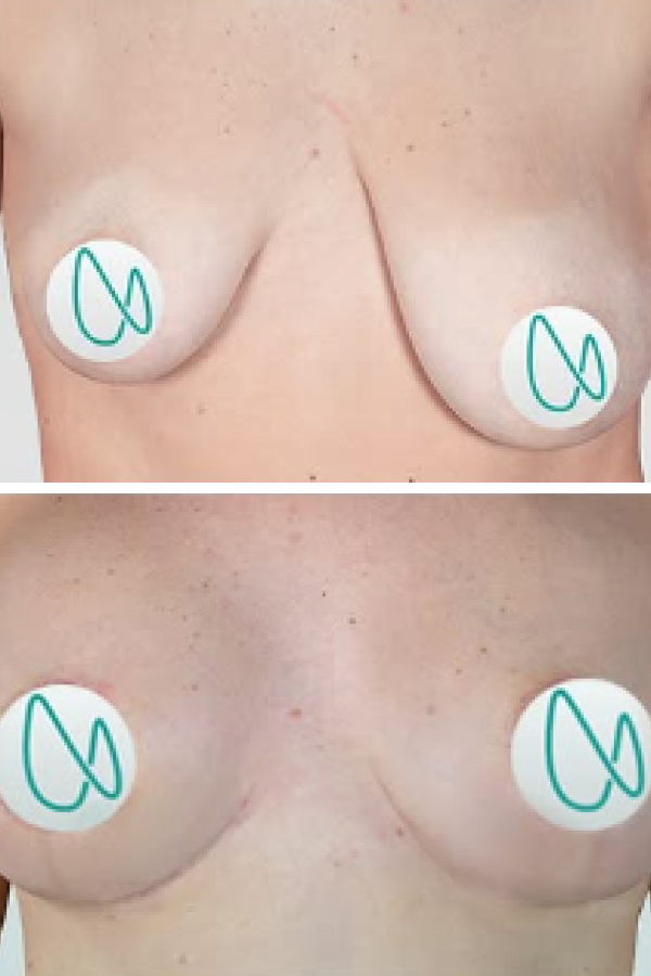 Estetik International's Breast Lift