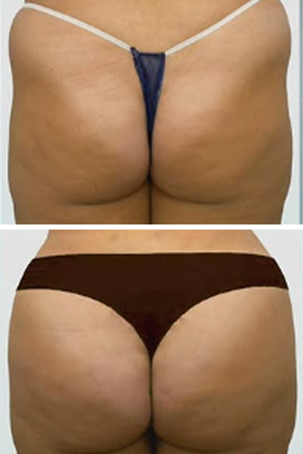 Estetik International's Laser Lipolysis