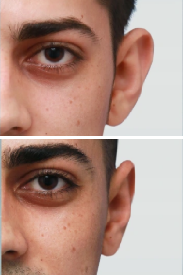 Estetik International's Otoplasty