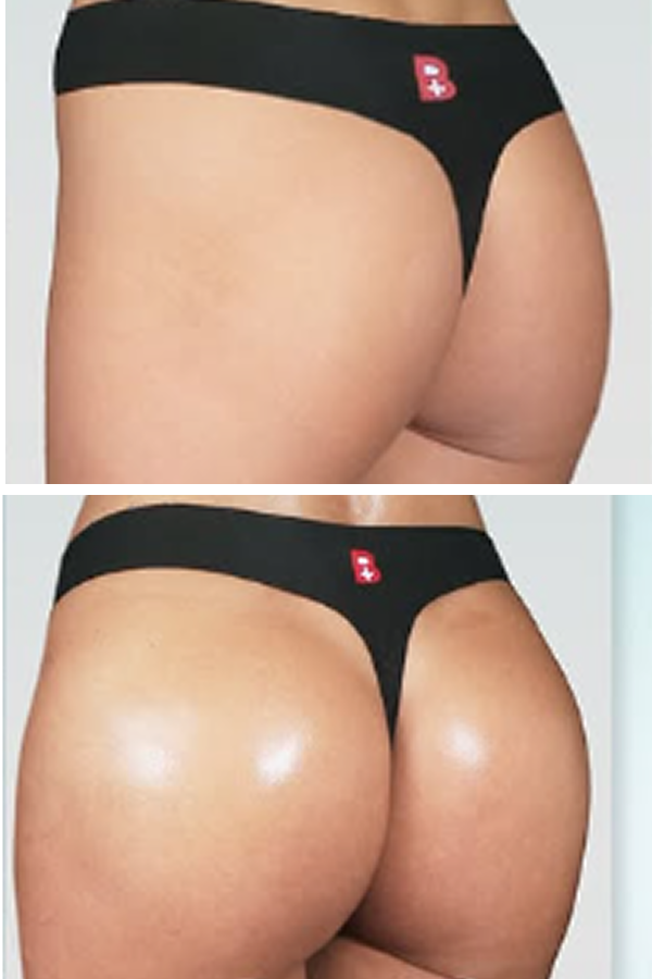 Estetik International's Brazilian Butt Lift (BBL)