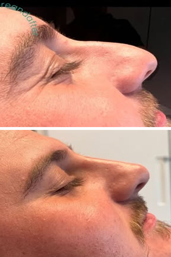 Estetik International's Rhinoplasty