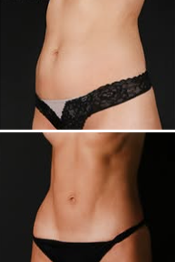Estetik International's Tummy Tuck