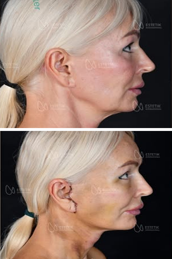 Estetik International's Cheek Augmentation