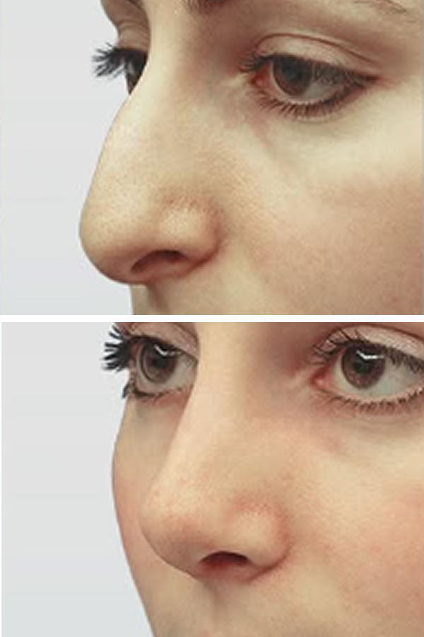 Estetik International's Rhinoplasty