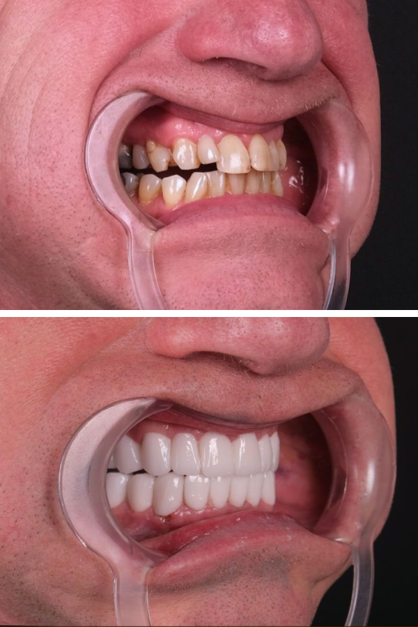 Estherian Dental Clinic's Dental Bridges