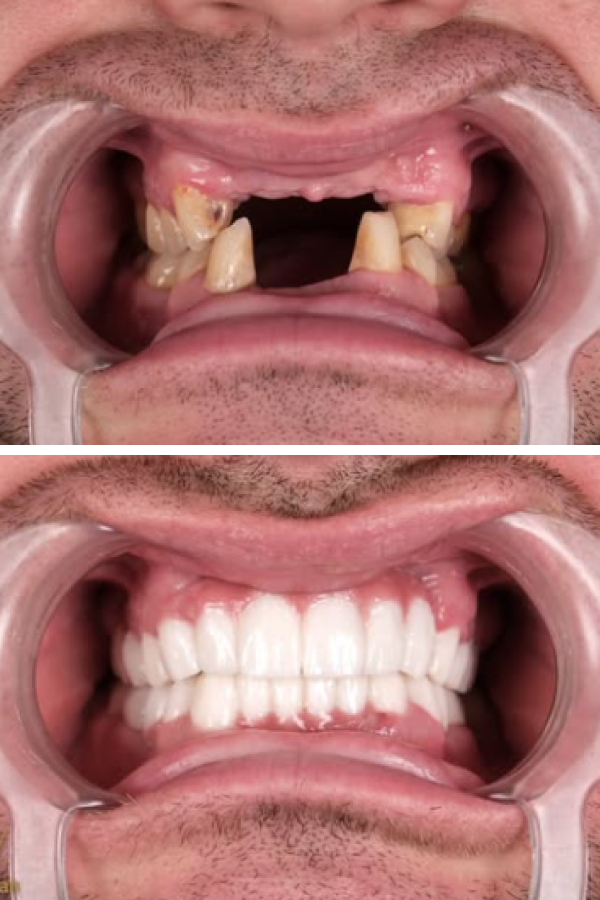 Estherian Dental Clinic's All-on-4 Dental Implants