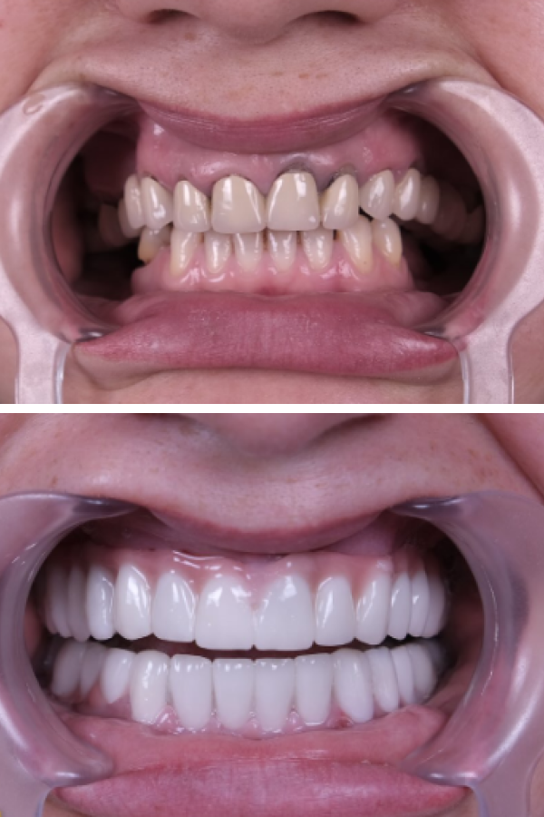 Estherian Dental Clinic's Single Dental Implant