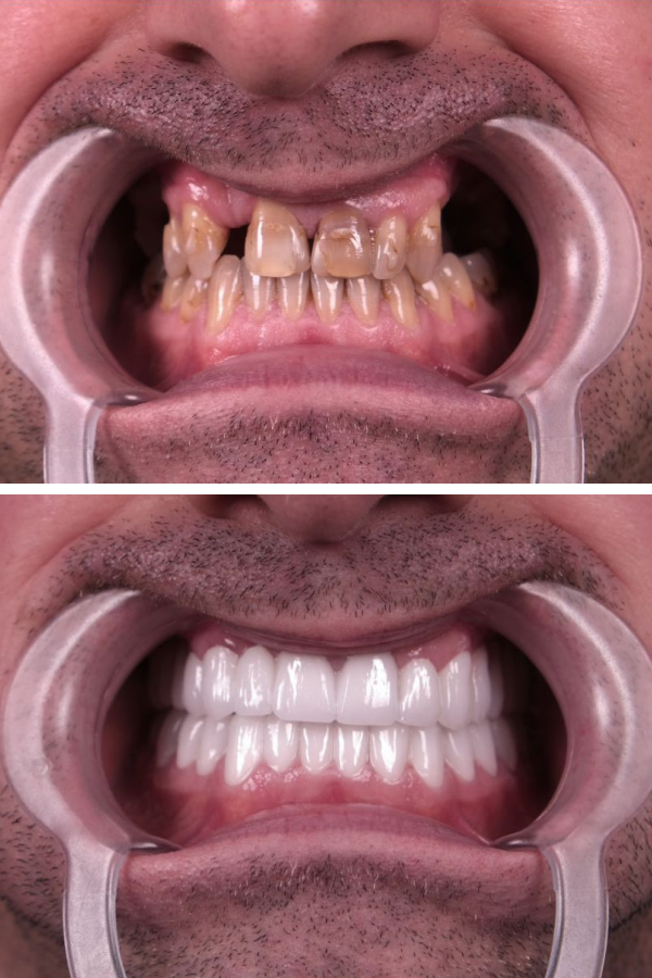 Estherian Dental Clinic's Composite Veneer