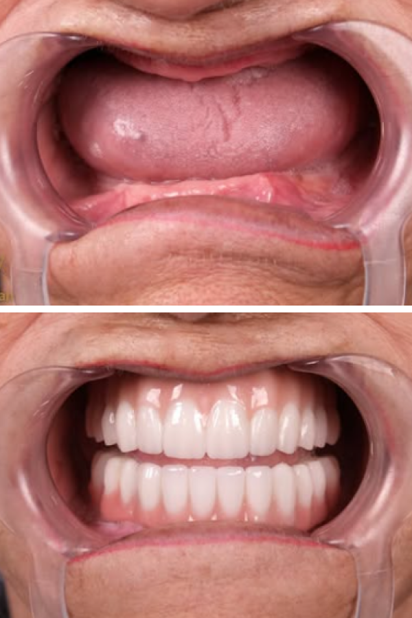 Estherian Dental Clinic's All-on-6 Dental Implants