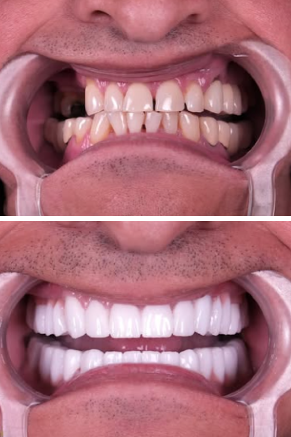 Estherian Dental Clinic's Invisalign Clear Aligners