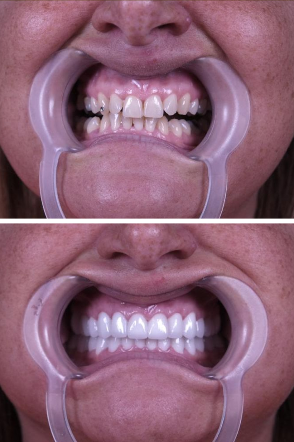 Estherian Dental Clinic's Dental Crowns