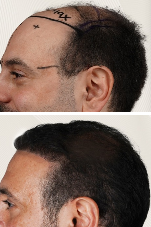 Turkeyana Clinic's Hair Transplantation