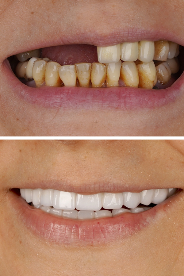 Turkeyana Clinic's All-on-4 Dental Implants