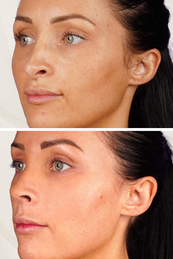 Turkeyana Clinic's Rhinoplasty
