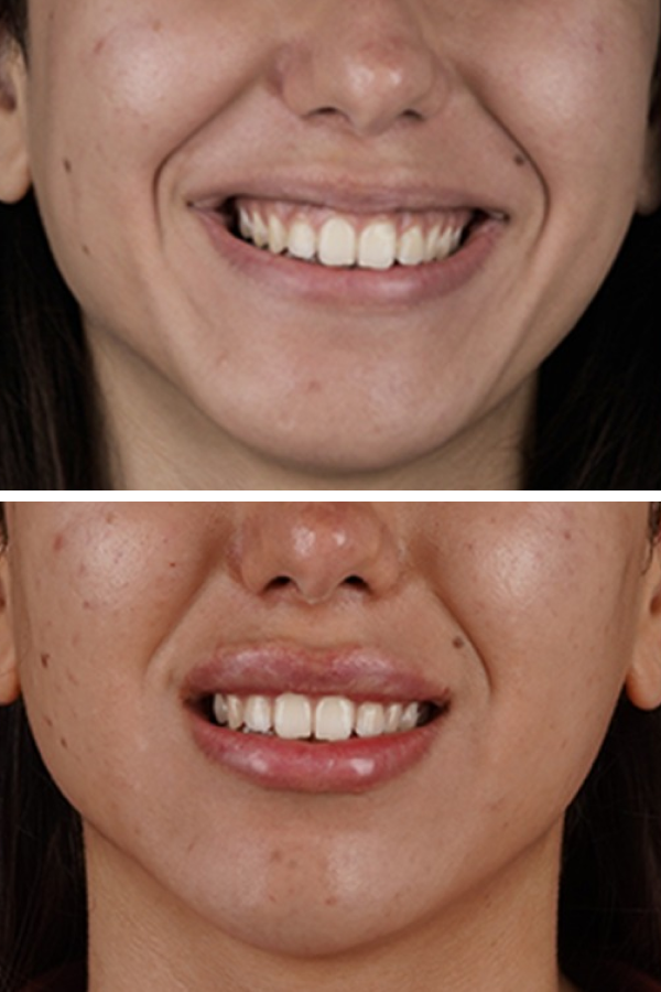 Turkeyana Clinic's Botox