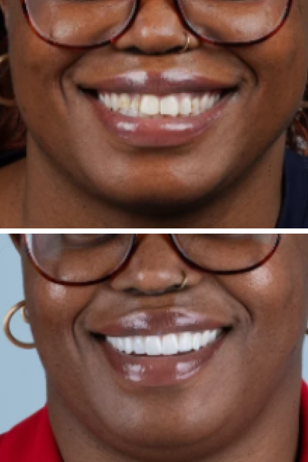 Turkeyana Clinic's Dental Veneers