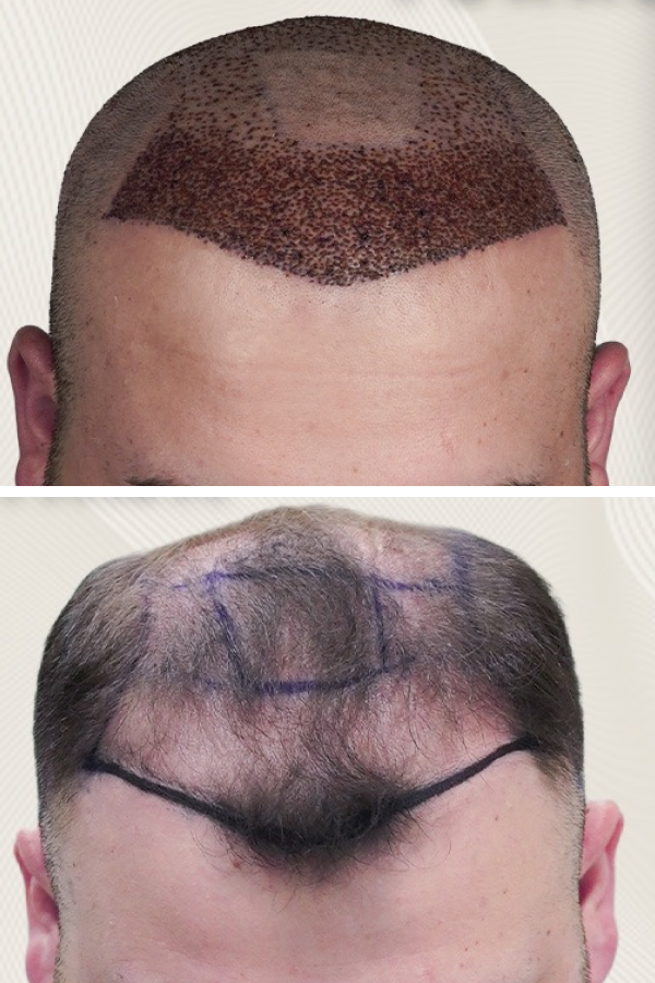 Turkeyana Clinic's Hair Transplantation
