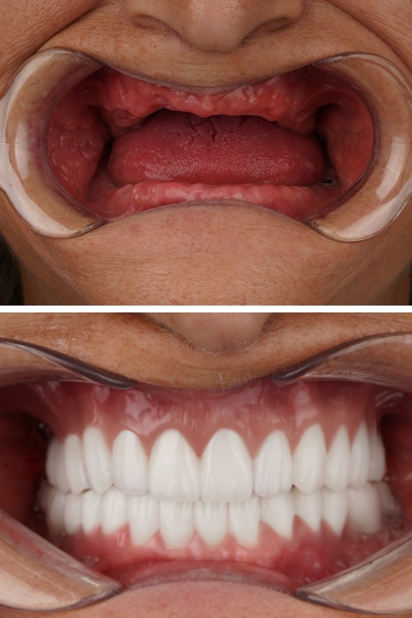 Turkeyana Clinic's Dental Veneers