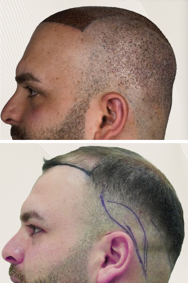 Turkeyana Clinic's Hair Transplantation