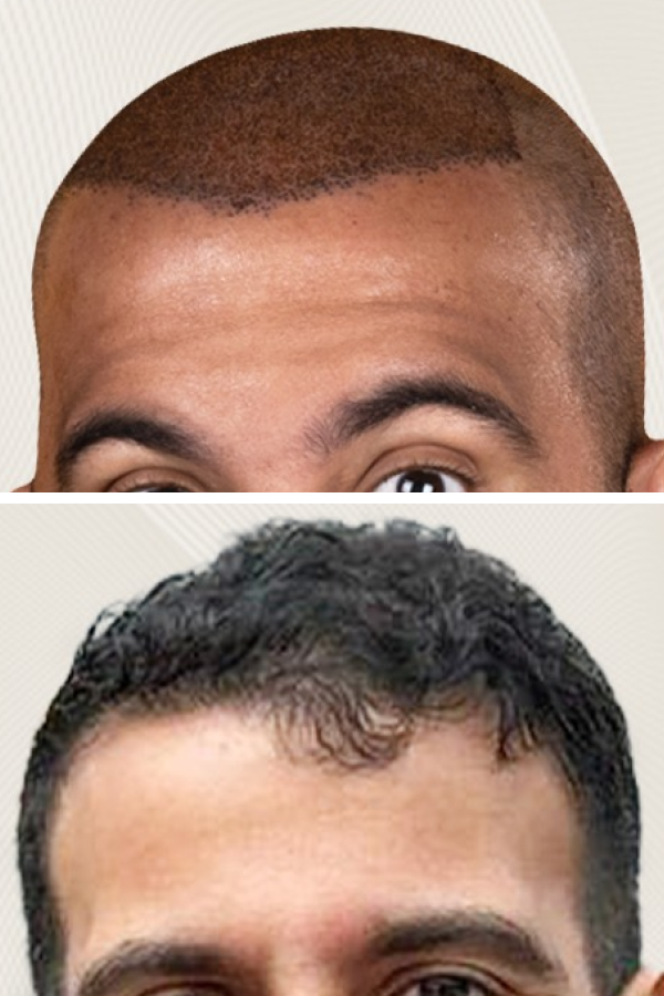 Turkeyana Clinic's Hair Transplantation