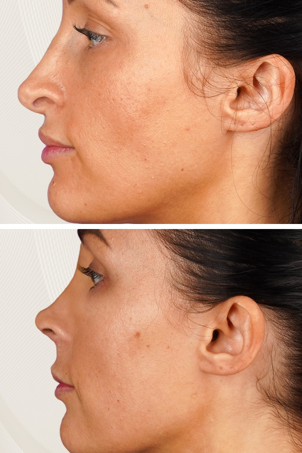 Turkeyana Clinic's Rhinoplasty